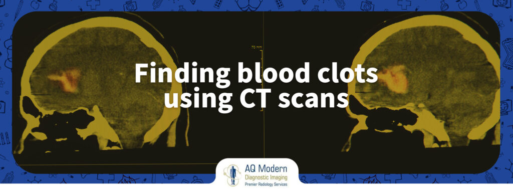 How to Find Blood Clots using CT Scans