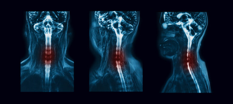 Cervical Lordosis: Symptoms - Diagnosis - Treatment - Causes And Risk